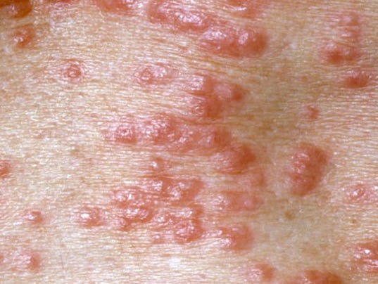 Scabies Home Remedies, Treatment, and Images