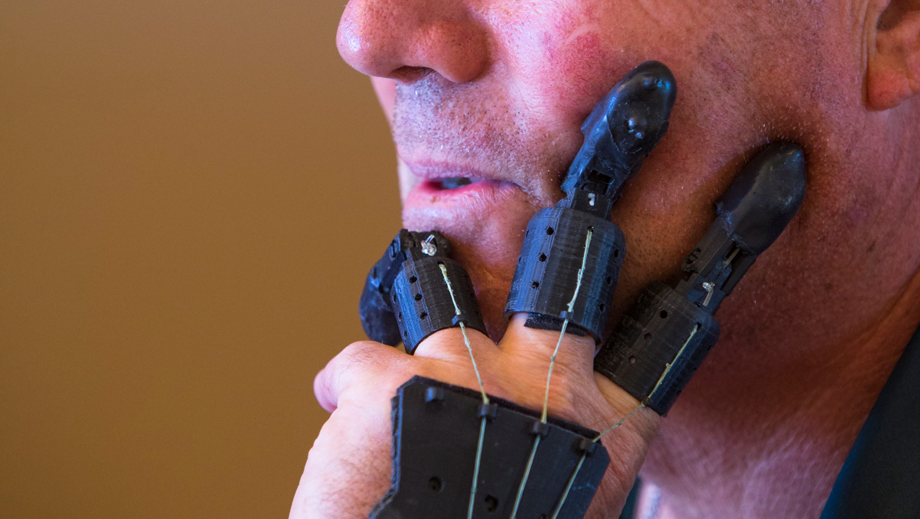 finger prothesis Dan didrick is the inventor of x-fingers, stainless steel prosthetic fingers in which each digit contains 23 moving parts or more for those without residual fingers. finger prothesis Dan didrick is the inventor of x-fingers, stainless steel prosthetic fingers in which each digit contains 23 moving parts or more for those without residual fingers.