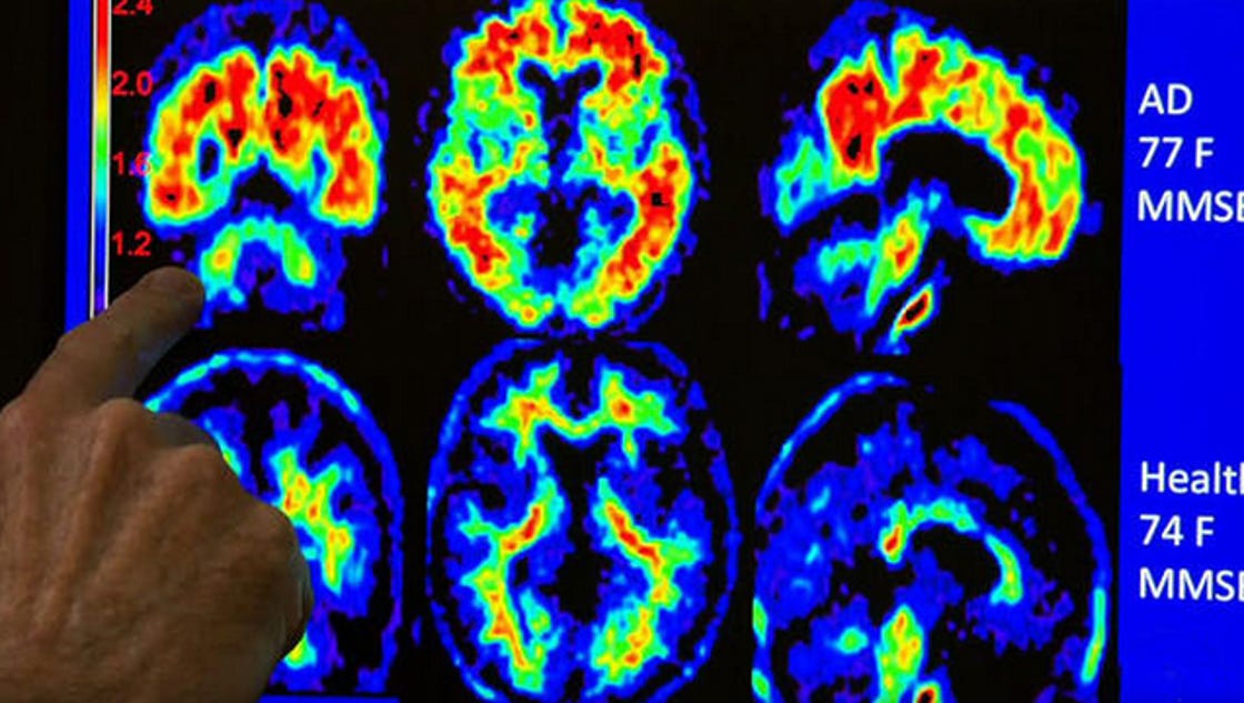 Ultrasound treatment targets Alzheimer's brain plaque