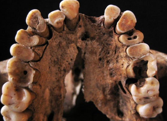 Tooth decay in early humans