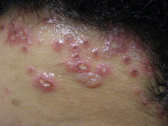 Impetigo All We Need Is Cheez Impetigo All We Need Is Cheez