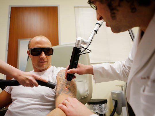 Tattoo removal takes a laser leap forward