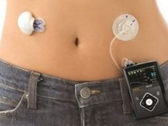 Medtronic Artificial Pancreas >> 'Artificial pancreas' is one of new tech devices aimed at ... Medtronic Artificial Pancreas >> 'Artificial pancreas' is one of new tech devices aimed at ...