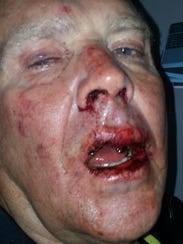 Former NASCAR driver Mike Wallace received stitches