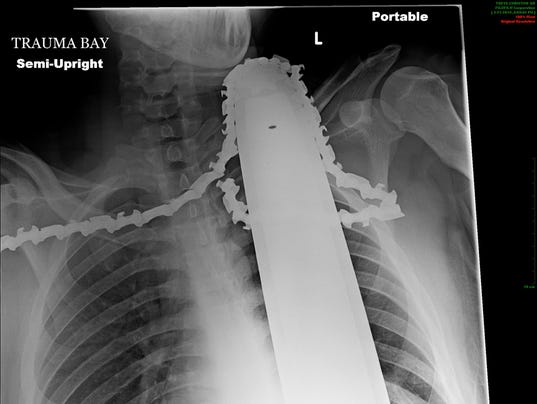 tree trimmer hospitalized with chain saw in neck democratic