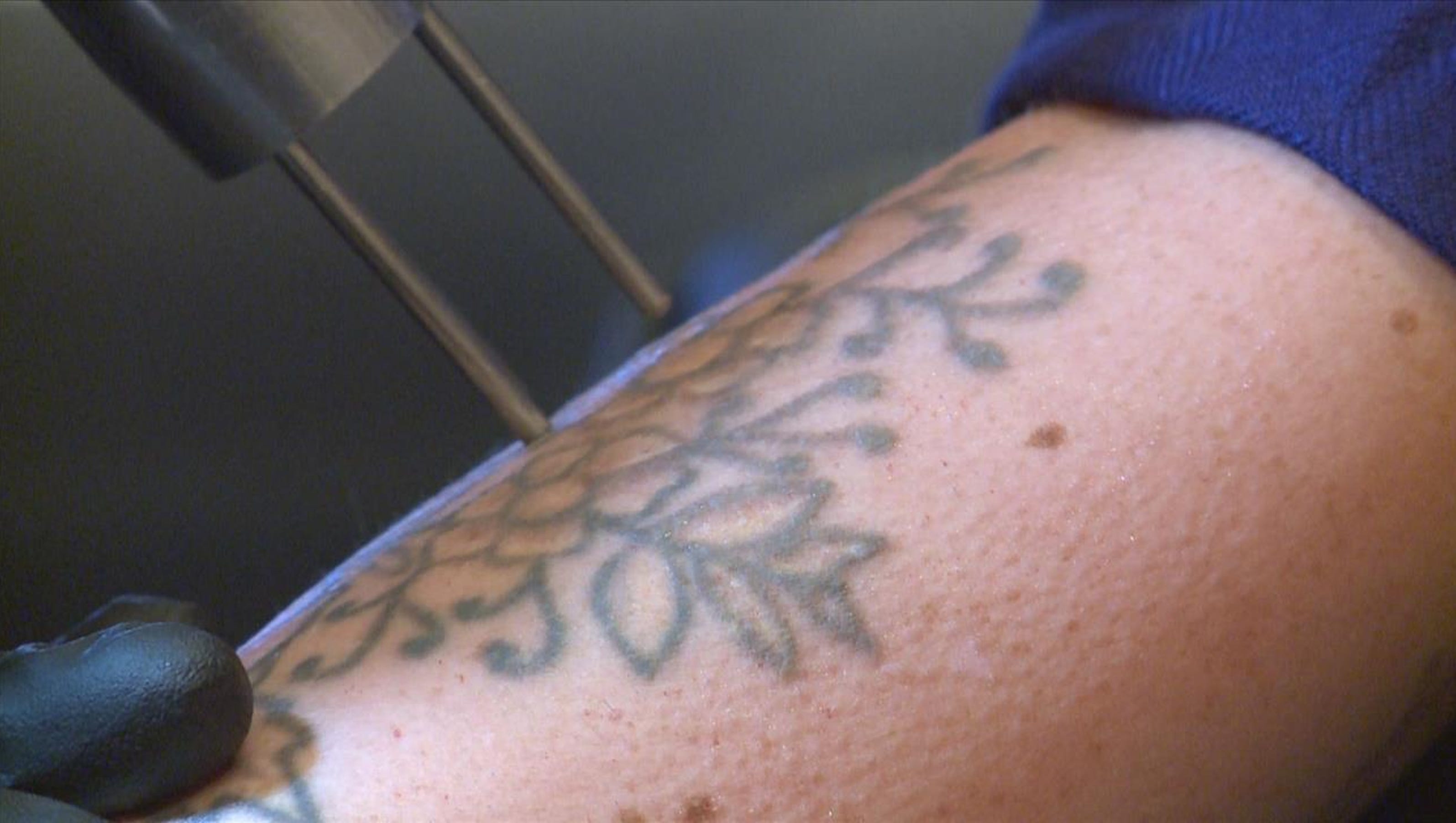 Tattoo Removal: The cost to erase ink