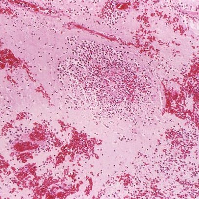 Under a low magnification of 96X, this hematoxylin-eosin stained (H&E) photomicrograph reveals some of the histopathologic changes seen in a lymph node tissue sample in a case of fatal human plague.