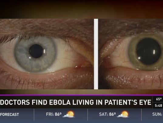 Ebola found in doctor's eye months after virus left his blood