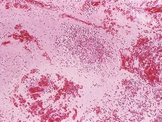 Plague case confirmed in Michigan