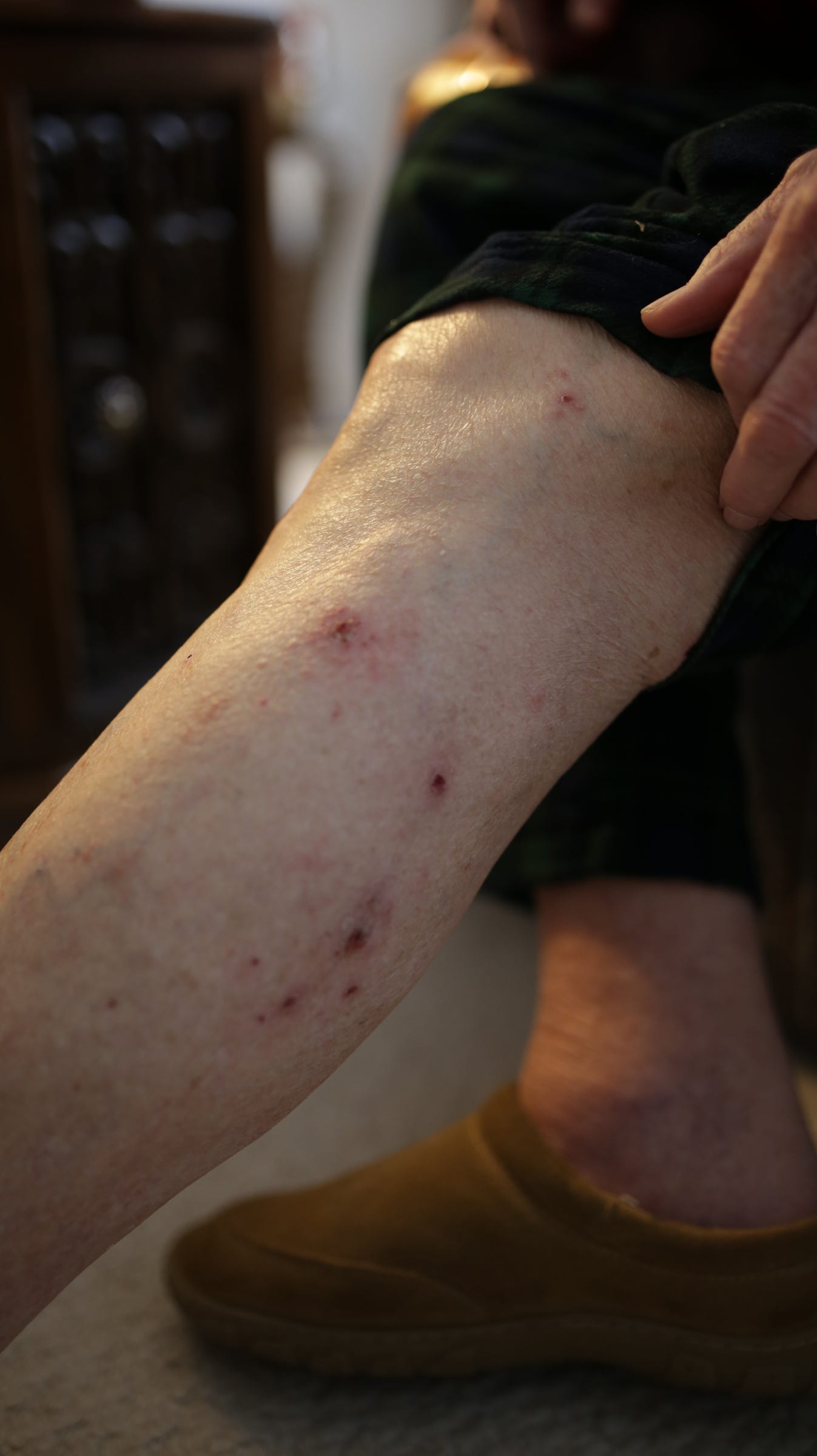 Emails show feds knew of rashes in Flint in mid2014