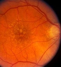 This photograph shows the macula (central retina) of a patient with dry AMD, showing the yellowish deposits called 