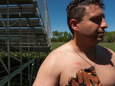 The scar from Jonathan Stelly's pacemaker surgery is visible on his chest. Stelly had dreams of playing professional baseball, but the surgery he had at 22 meant it would never happen. He later learned that he hadn't needed the surgery.