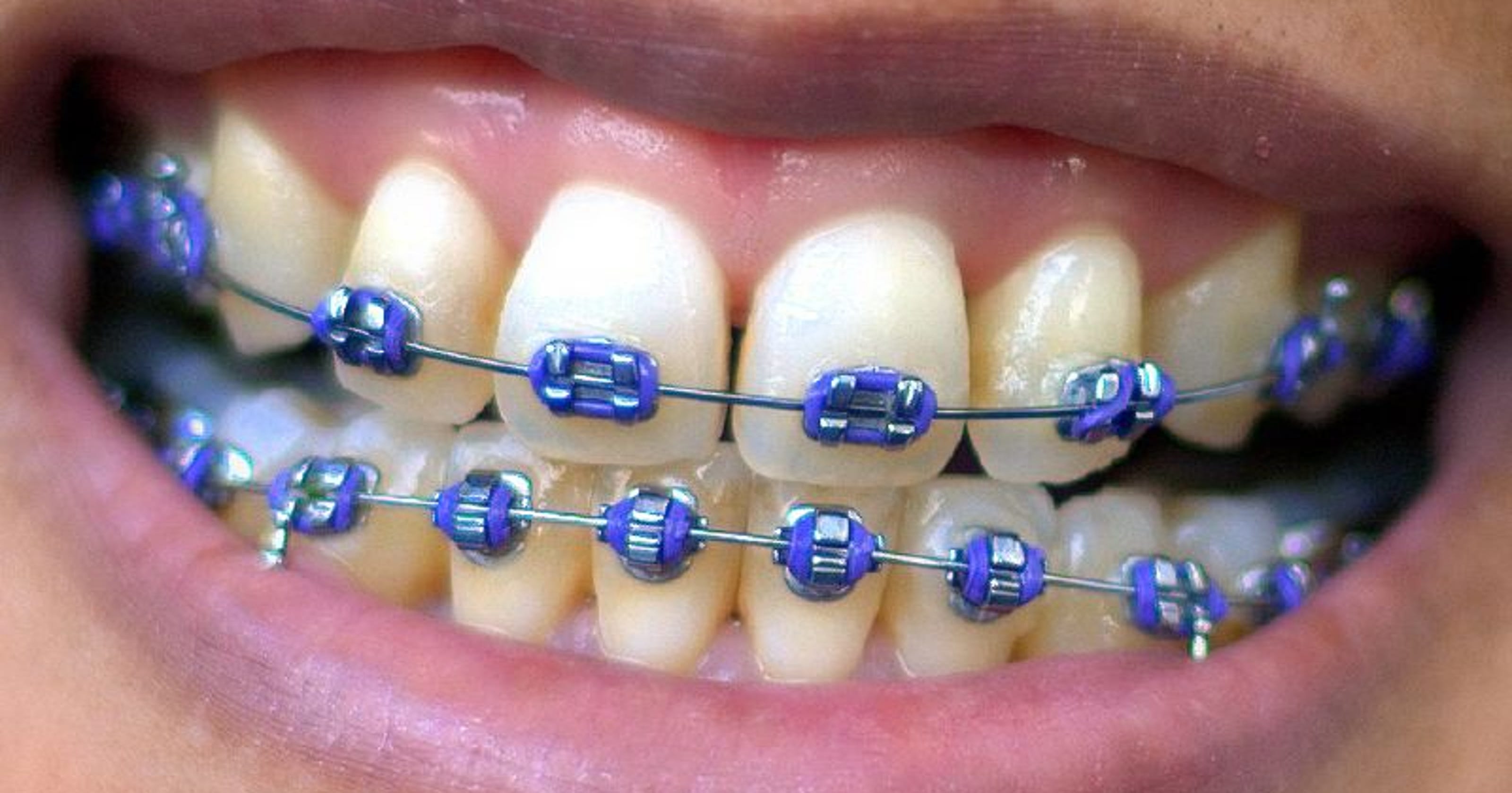Braces 101 All about orthodontia