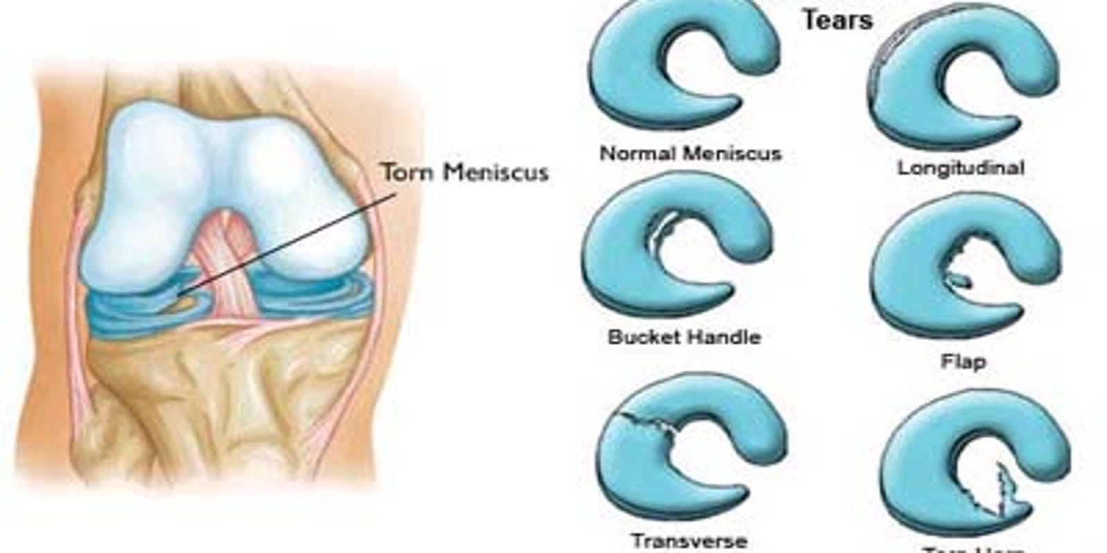 The Injury Zone Meniscus Tear, What are my options?