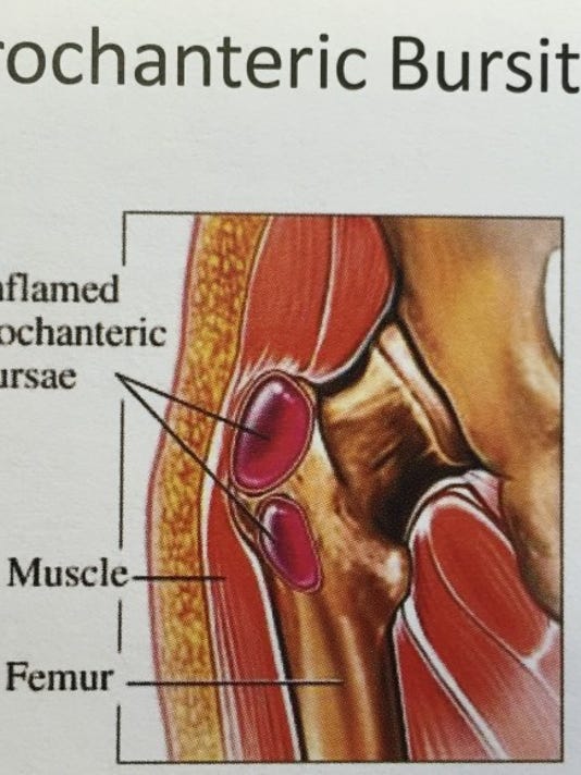 The Injury Zone: Hip Bursitis