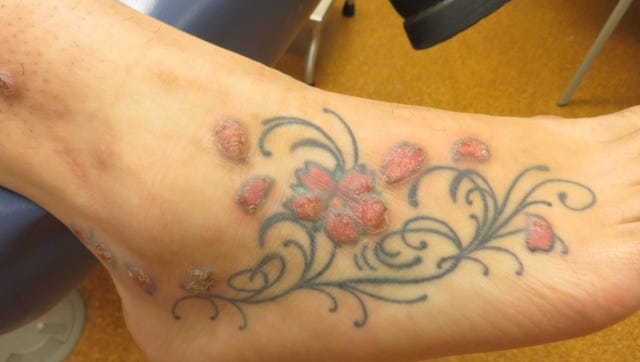 Tattoos have gone mainstream, but they still carry risks Tattoos have gone mainstream, but they still carry risks