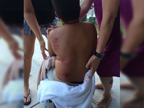 Brison Aldridge was attacked by a pit bull mix in Manor, Texas, on Monday.
