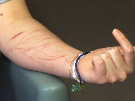 Self-mutilation scars.