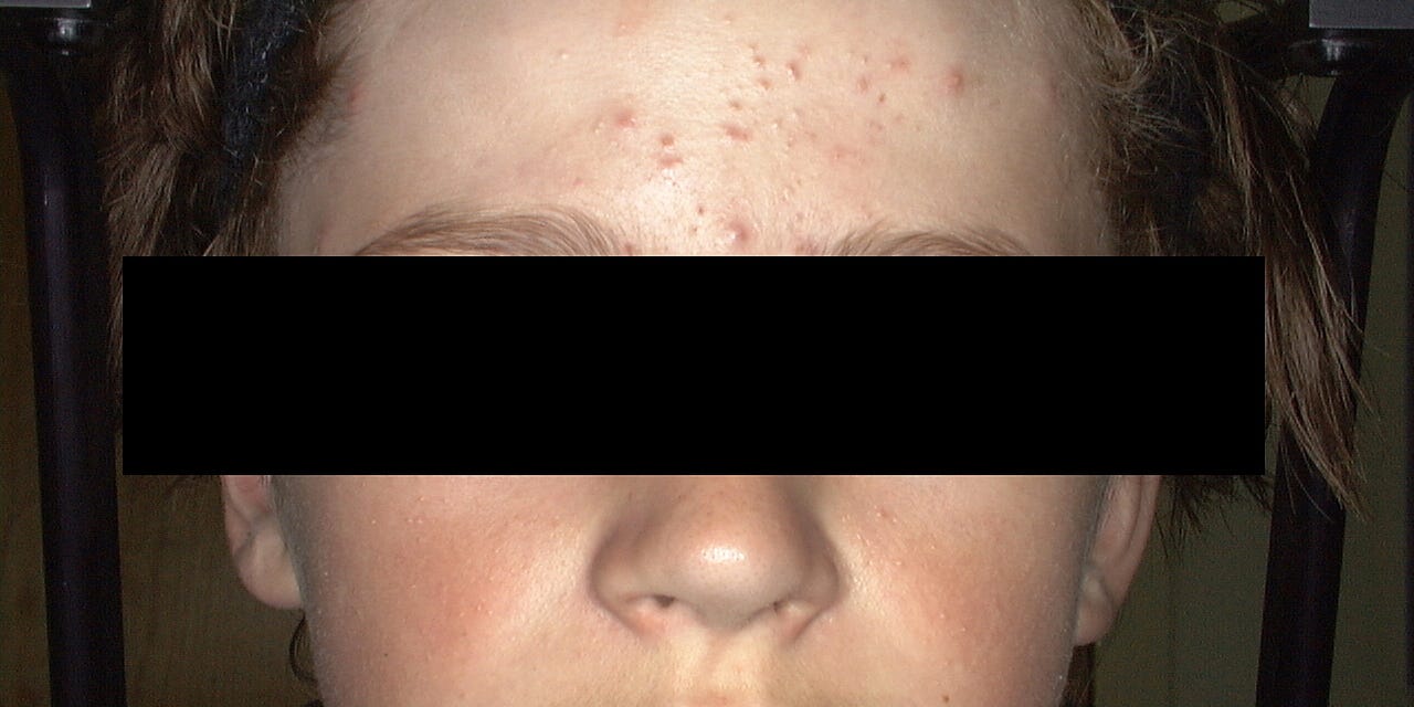 Kids Are Getting Acne Younger Than Ever Doctors Say