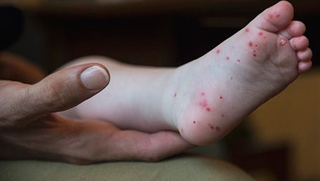 The classic blisters associated with hand, foot and mouth disease.