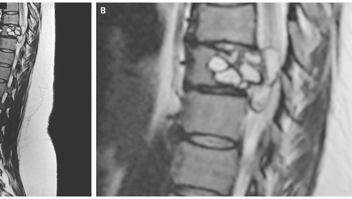 Parasite In Woman S Spine Causes Tingling Sensation Trouble Walking