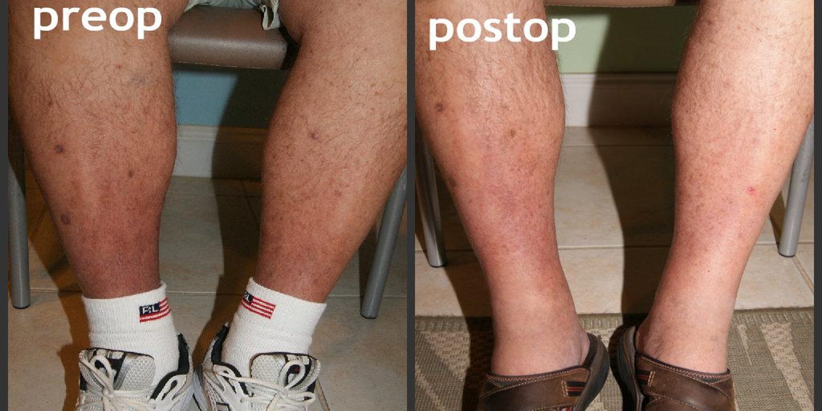 Wound won’t heal? Could be veins
