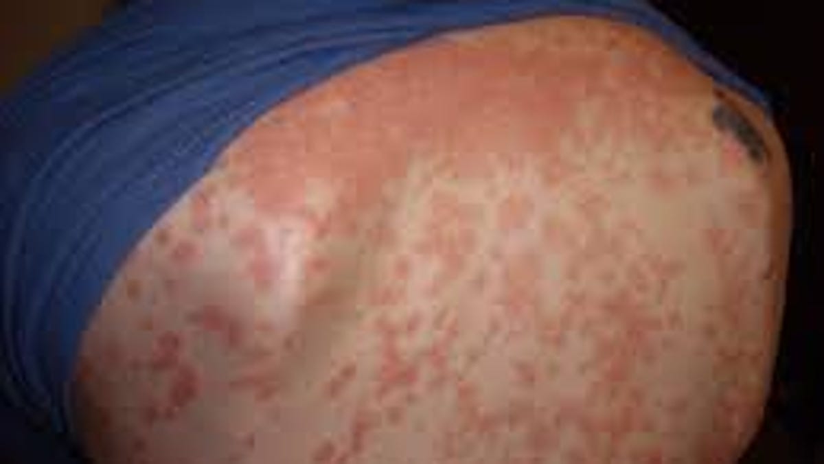 Psoriasis serdülők