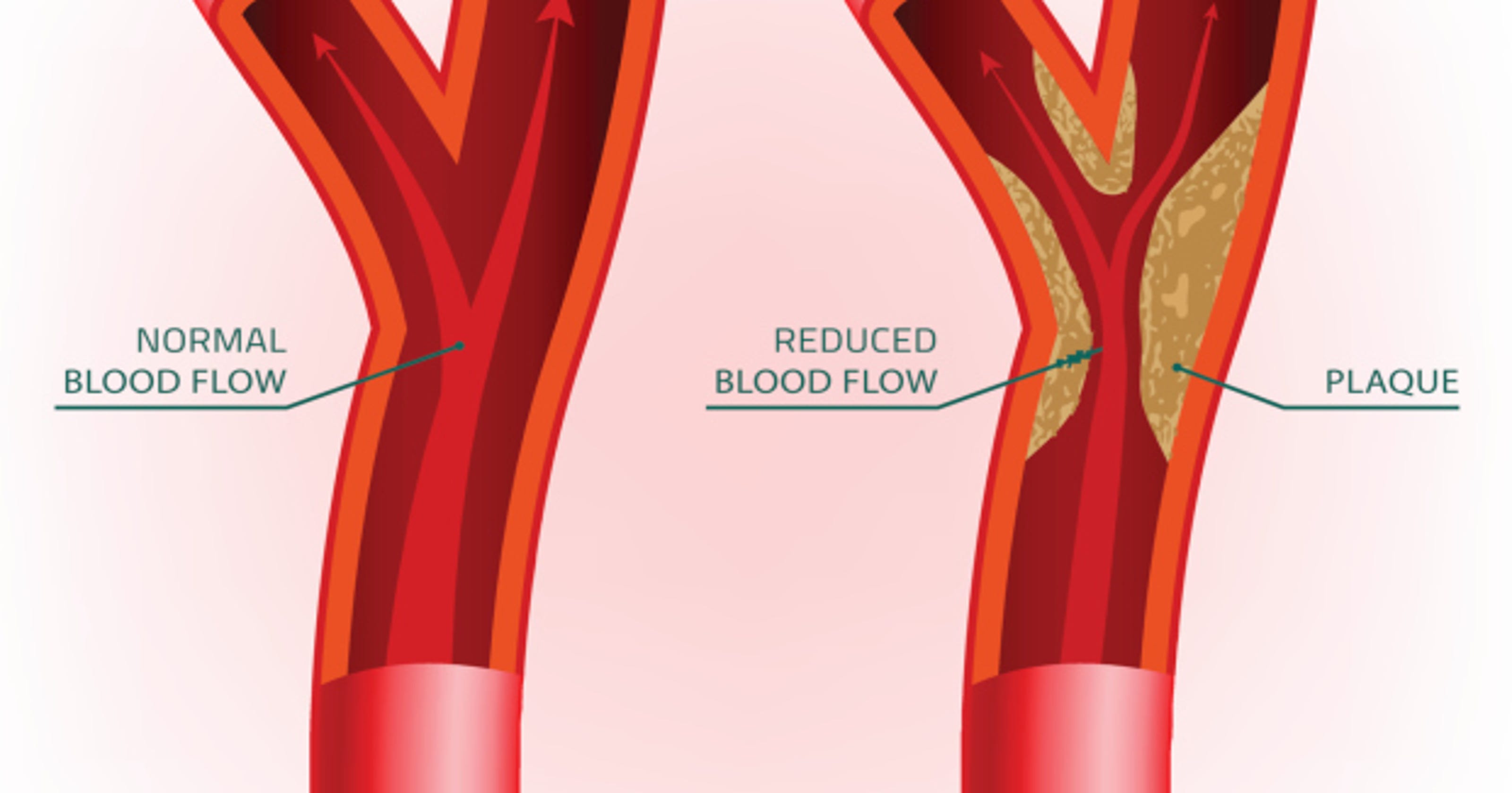 Coronary Calcium Scan results then vs. now
