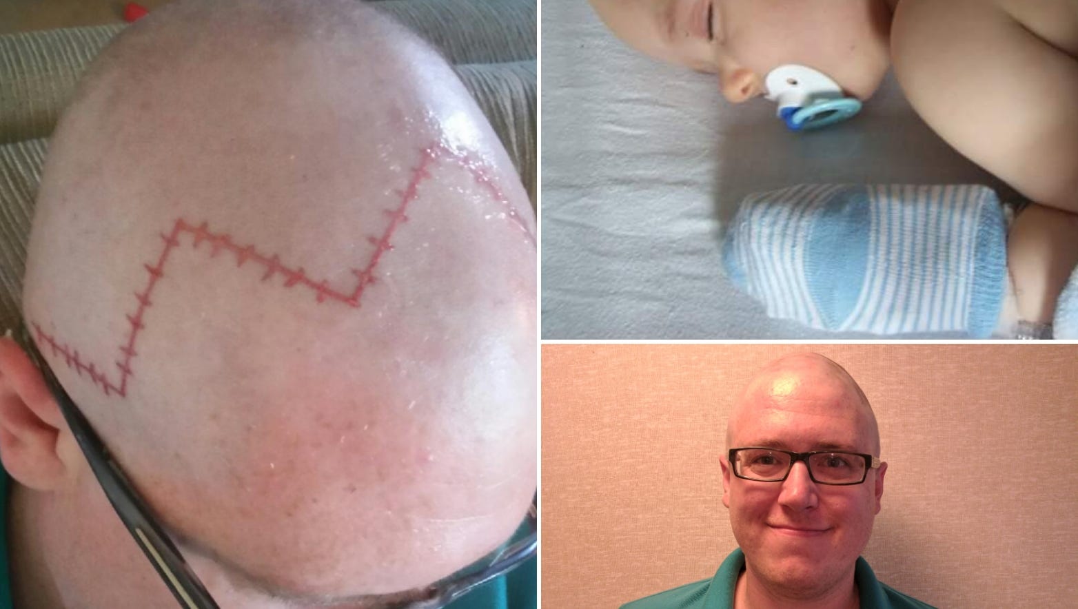 Chippewa Falls father tattoos scar on head for son who had brain surgery Chippewa Falls father tattoos scar on head for son who had brain surgery