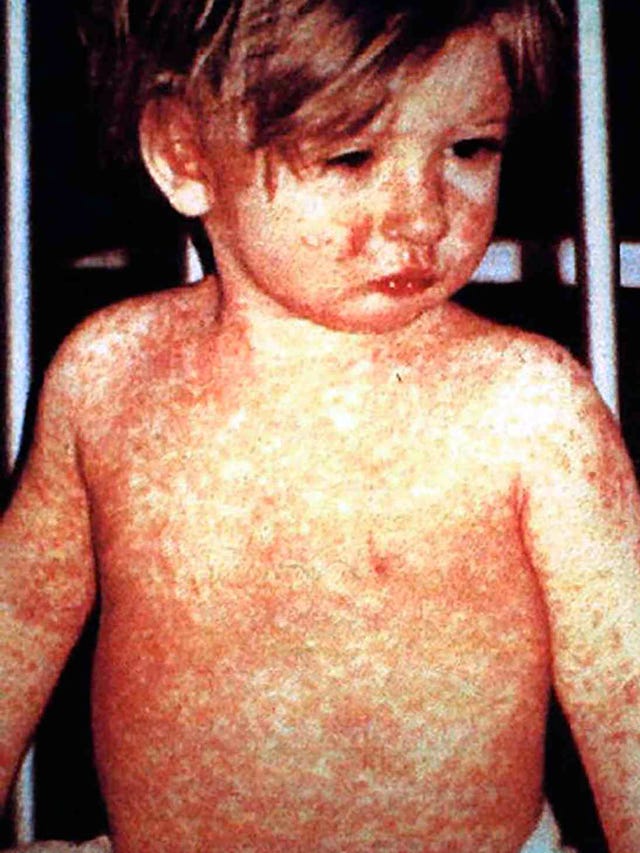 This unidentified child has a 4-day-old measles rash.