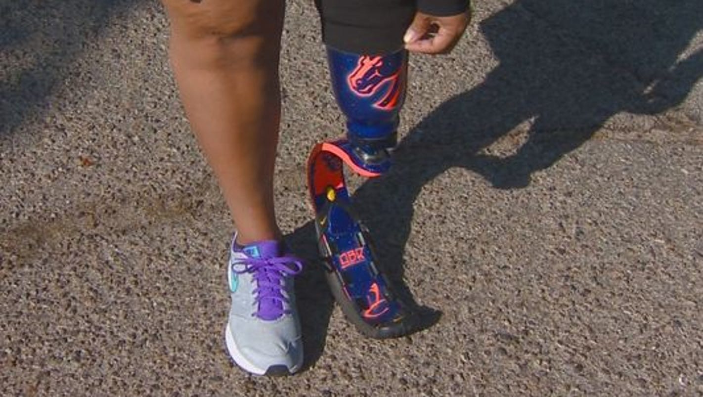 Mom loses her leg, but what she gains is priceless