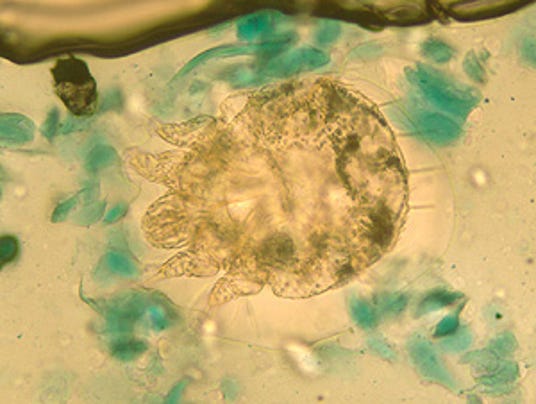 Bed Bug Under Skin