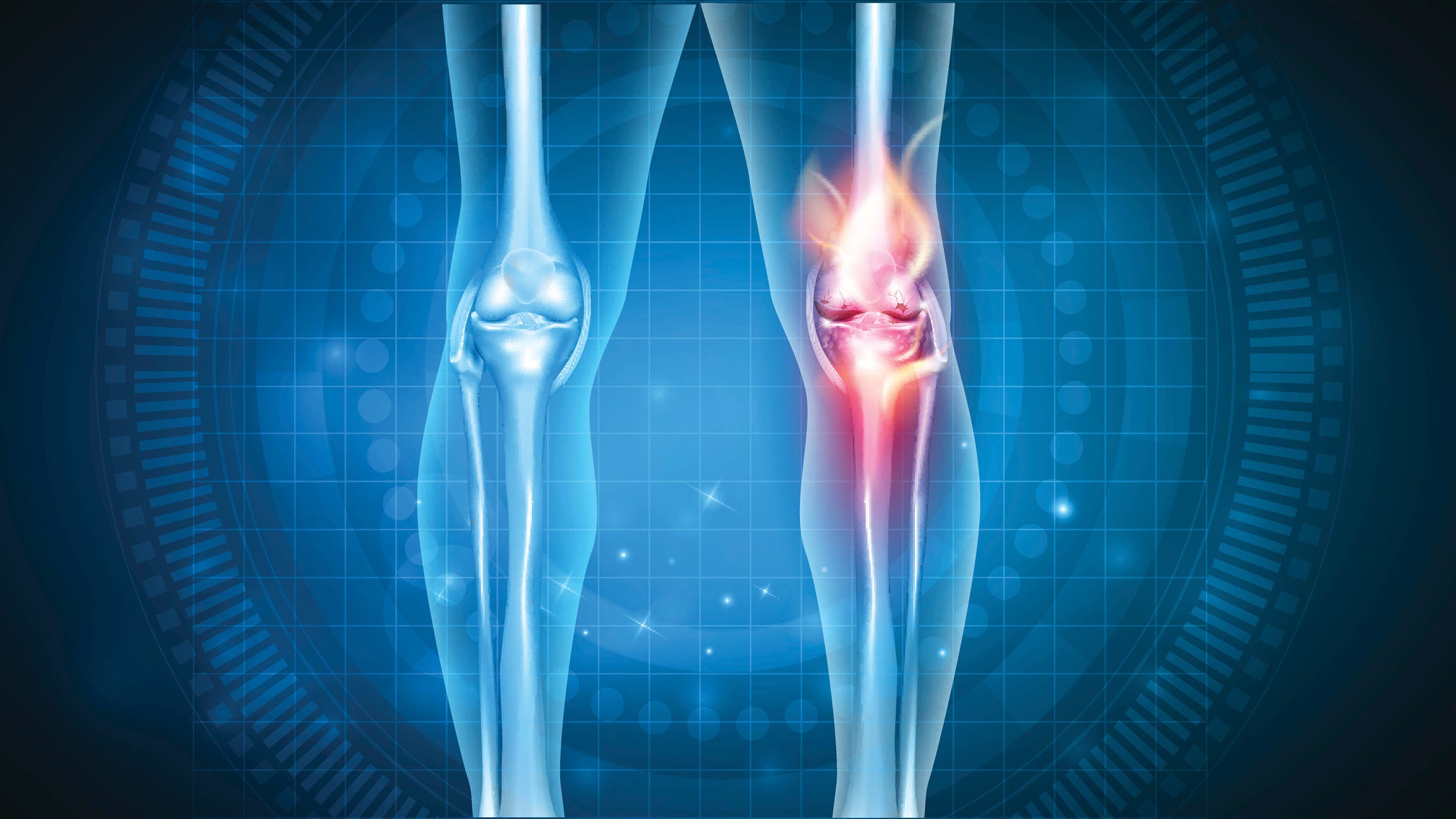Bone on bone: An overview of osteoarthritis types, risks, treatments