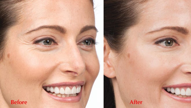 Clevens: How to ensure your best Botox result Clevens: How to ensure your best Botox result