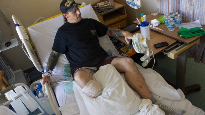 Lee County resident Zachary Motal had to have his leg removed last month after getting a severe infection. He had the surgery at HealthPark Medical Center.