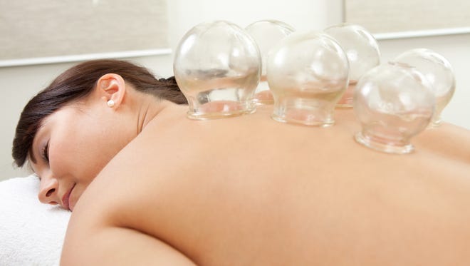 Cupping is natural and the only side effects are the temporary marks on the skin.