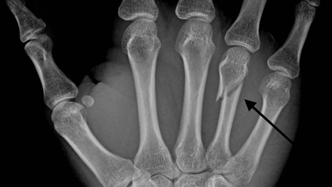 Can hand fractures heal quickly?