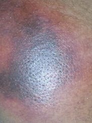 Photo allegedly shows bruising from hazing incident