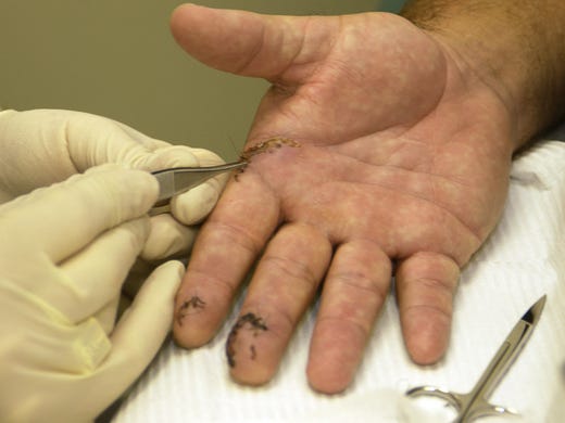 6-18-2008---John Vasbinder is having about 40 stitches