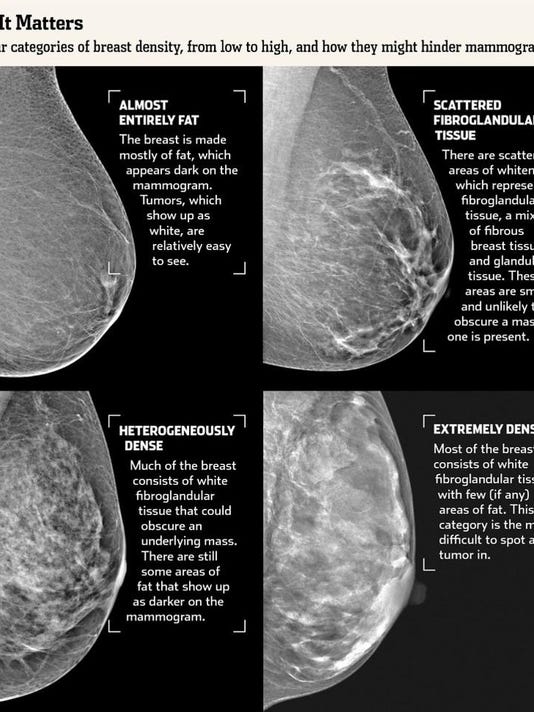 VT to alert patients on breast density