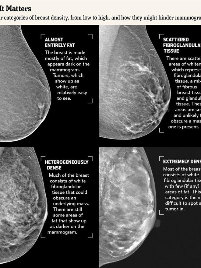 Vt Will Require Alerts About Breast Density Vt Will Require Alerts About Breast Density