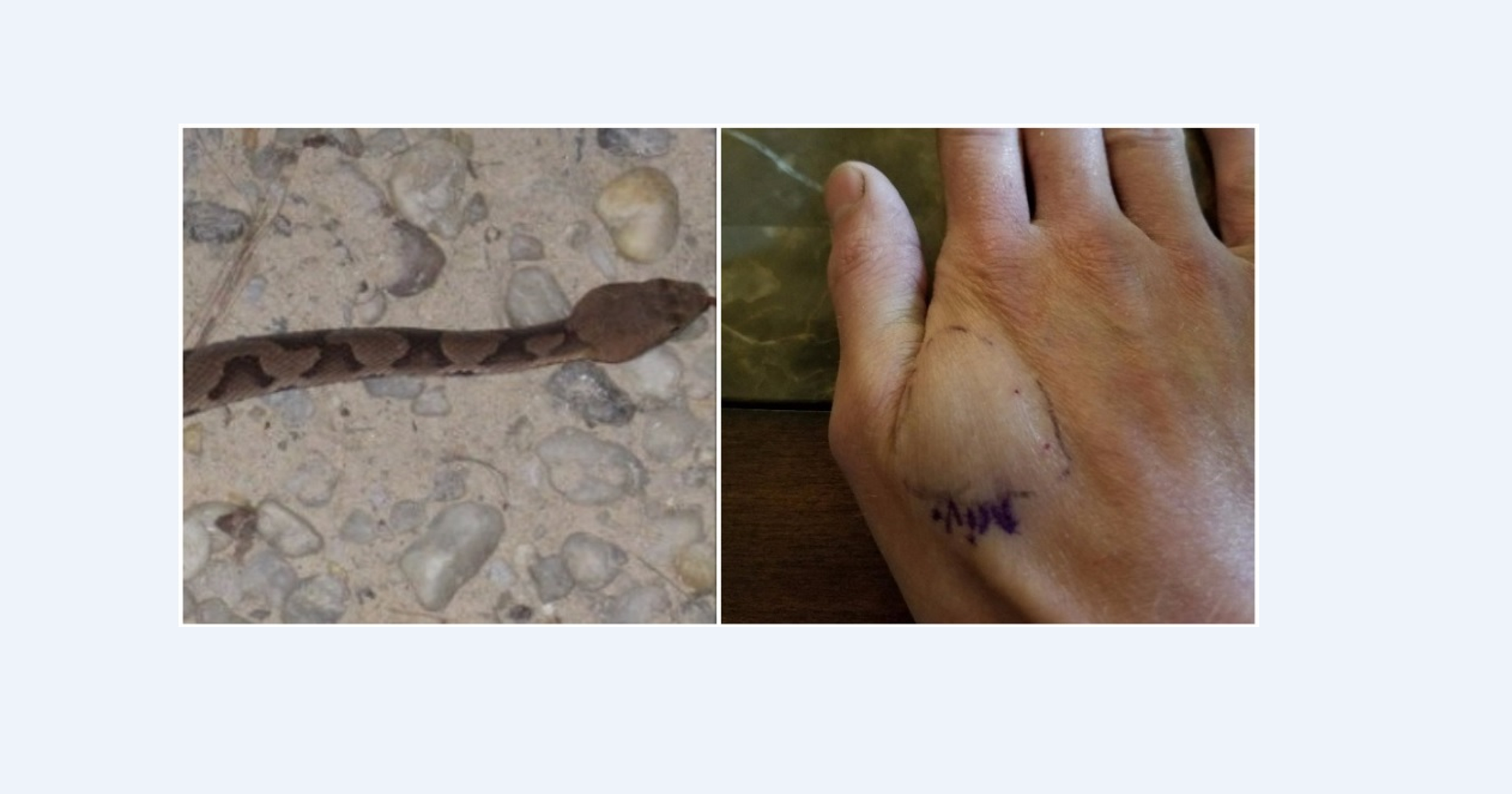Man bitten by copperhead snake in Republic