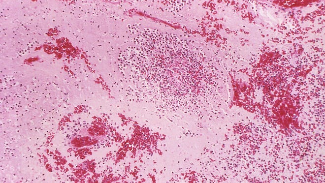 Under a low magnification of 96X, this hematoxylin-eosin stained (H&E) photomicrograph reveals some of the histopathologic changes seen in a lymph node tissue sample in a case of fatal human plague. Note the medullary necrosis accompanied by fluid due to the presence of Yersinia pestis bacteria.
