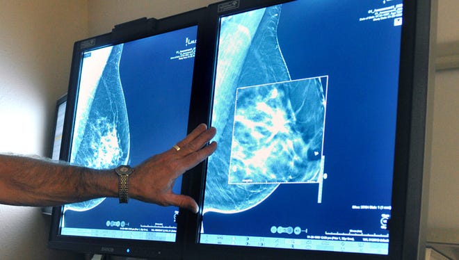 In this Tuesday, July 31, 2012, file photo, a radiologist compares an image from earlier, 2-D technology mammogram to the new 3-D Digital Breast Tomosynthesis mammography in Wichita Falls, Texas. The technology can detect much smaller cancers earlier. In guidelines published Tuesday, Oct. 20, 2015, the American Cancer Society revised its advice on who should get mammograms and when, recommending annual screenings for women at age 45 instead of 40 and switching to every other year at age 55. The advice is for women at average risk for breast cancer. Doctors generally recommend more intensive screening for higher-risk women.