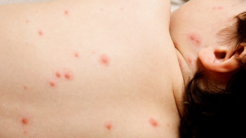 Public health officials reported four confirmed cases of chickenpox among school children in Trinity County.