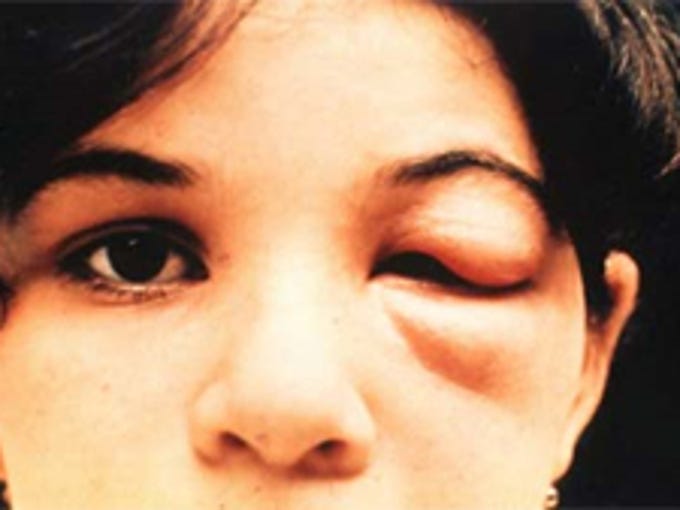 Texas Has 11 Types Of Kissing Bugs And All Carry Deadly