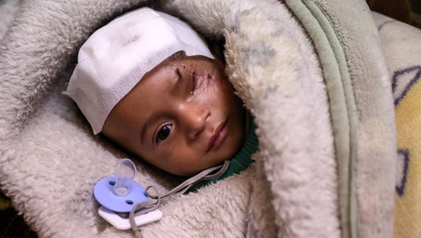 Karim, an infant who was injured twice from bombings
