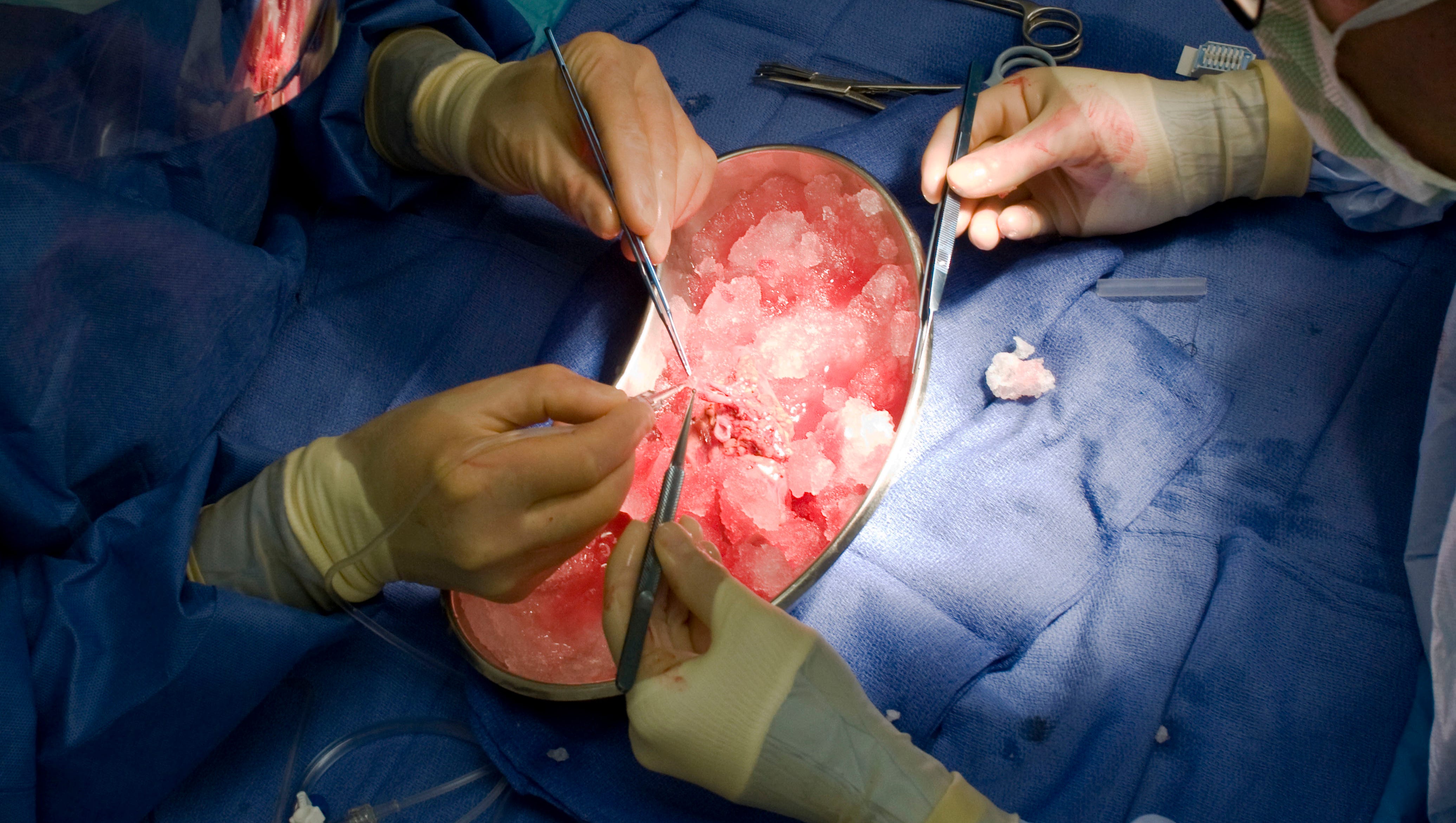 U S  Organ Transplants Reach 30k Milestone  Thanks To