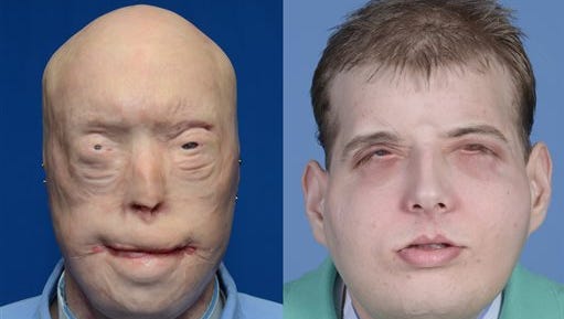 This combination of photos provided by the New York University Langone Medical Center shows Patrick Hardison before and after his facial transplant surgery in New York. Hardison was burned Sept. 5, 2001, in Senatobia, Miss.