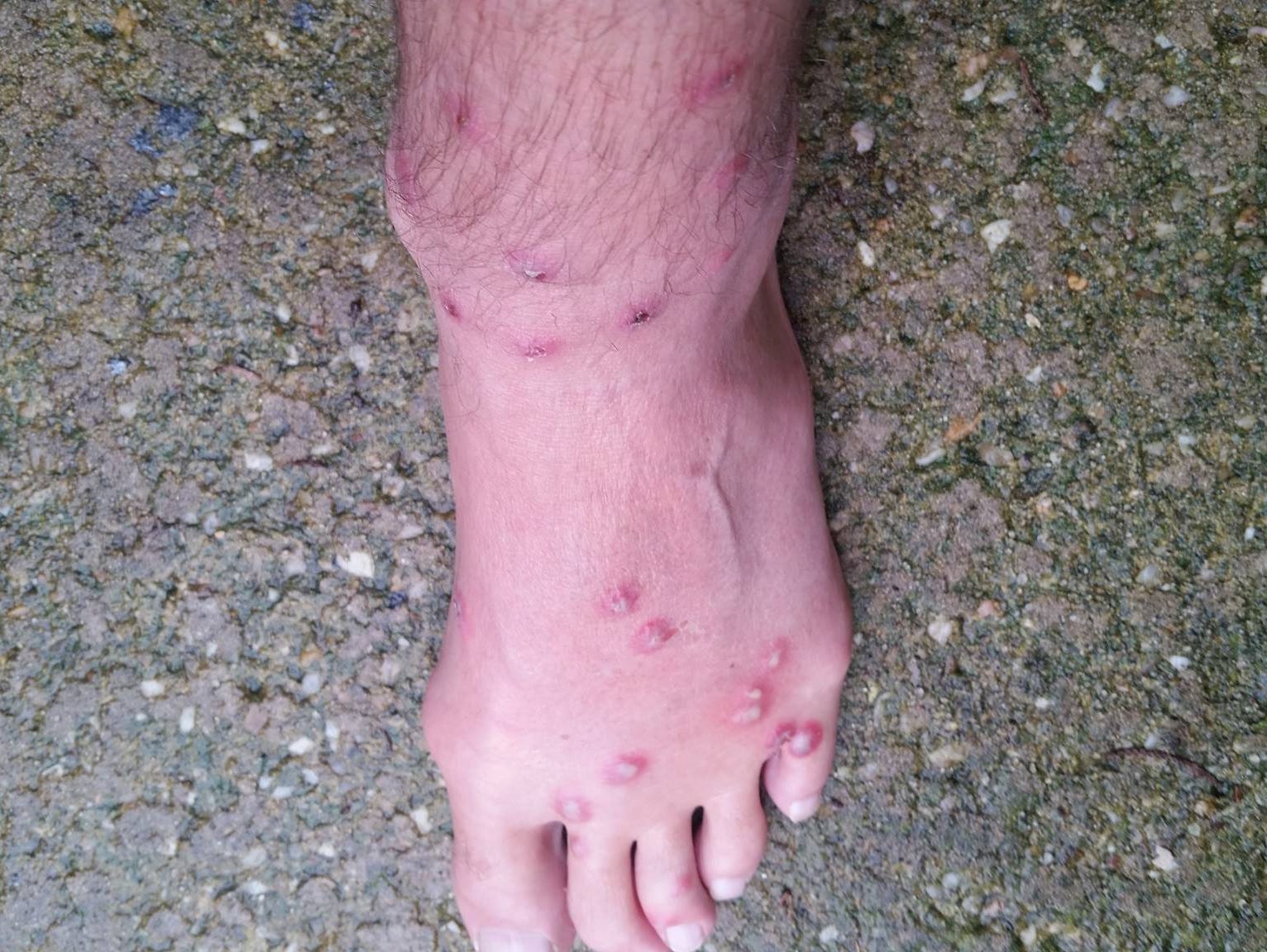 swimmers itch feet